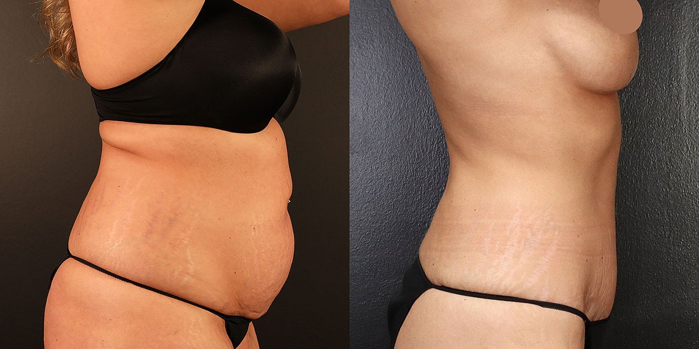 Before and after body transformation comparison image.