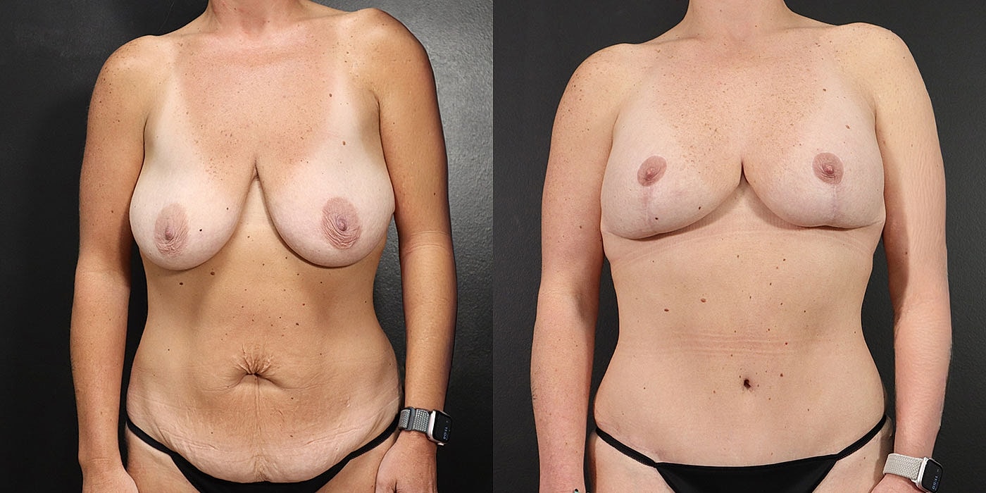 Before and after body transformation comparison image.