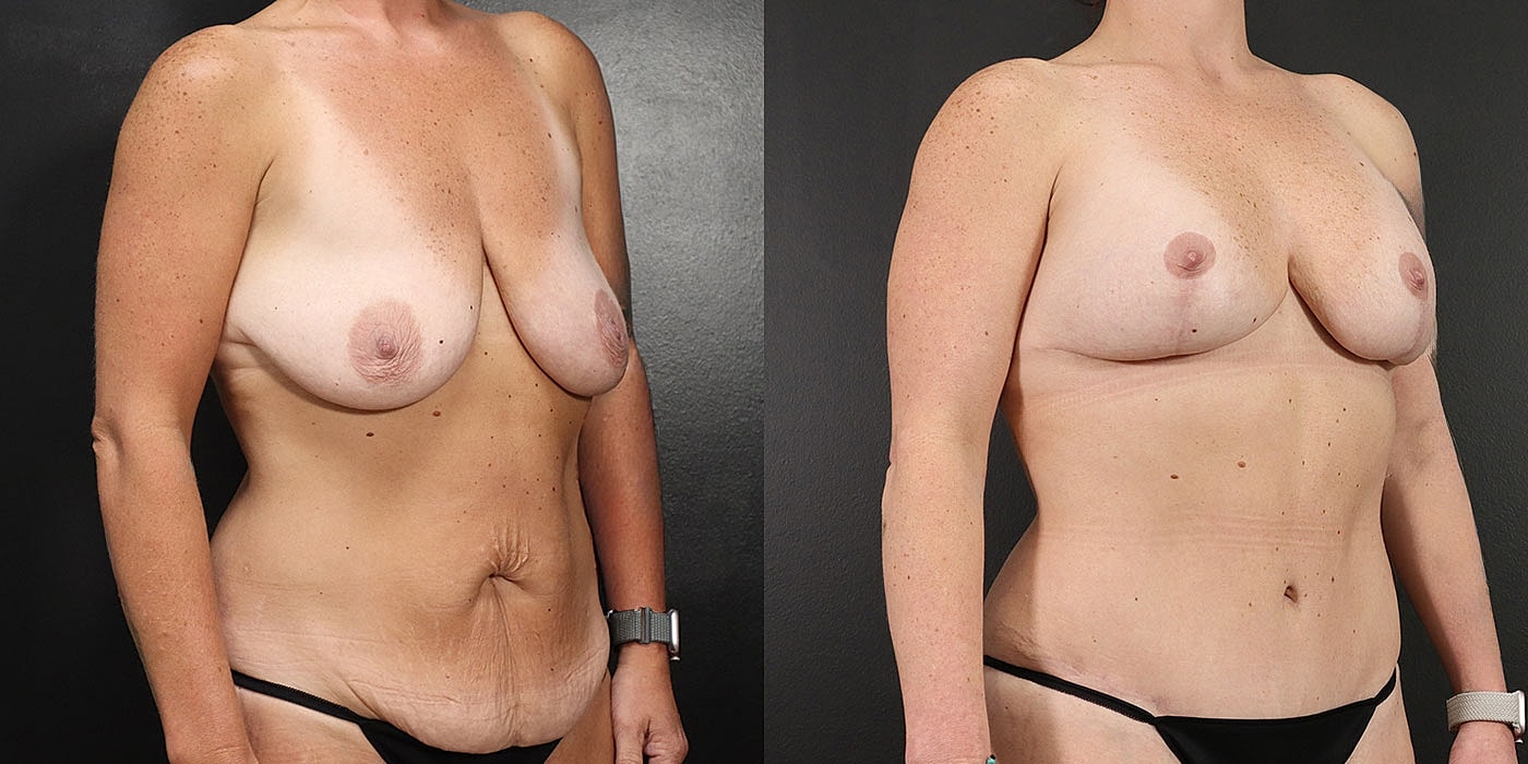 Before and after body transformation comparison.