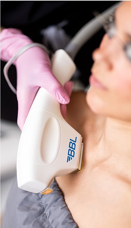 BBL skin treatment procedure in progress.