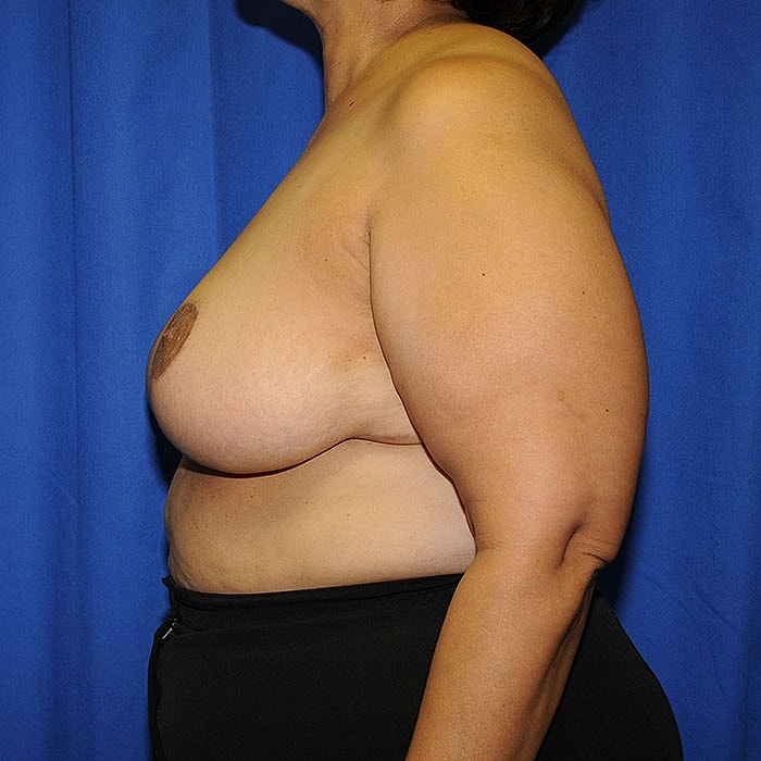 Breast Reduction Before & After