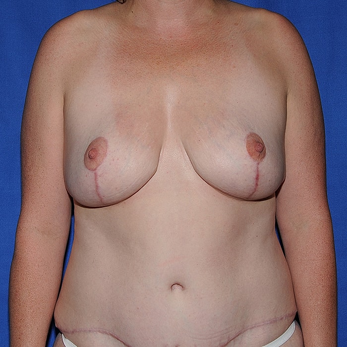 Breast Reduction Before & After