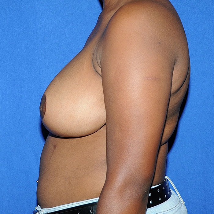 Breast Reduction Before & After