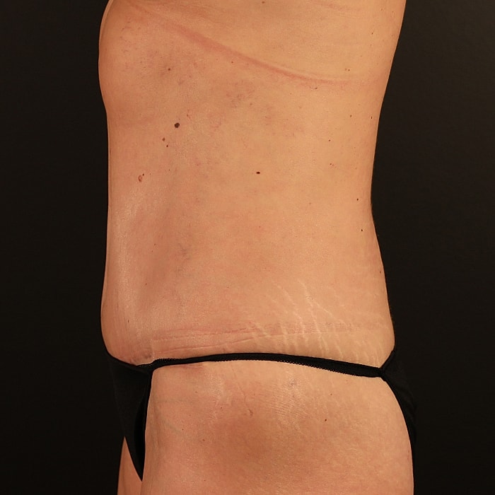 Abdominoplasty With Lipo Of Flanks Before & After