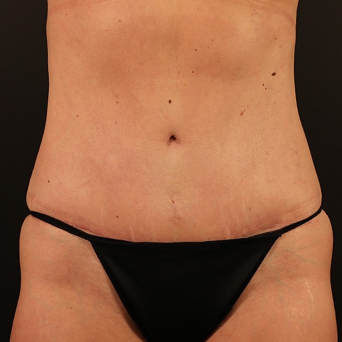 Abdominoplasty With Lipo Of Flanks Before & After