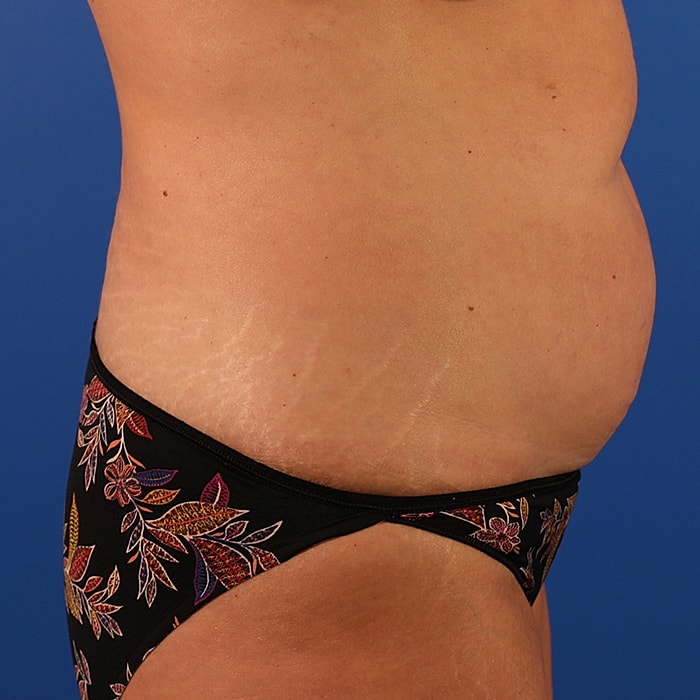 Abdominoplasty With Lipo Of Flanks Before & After