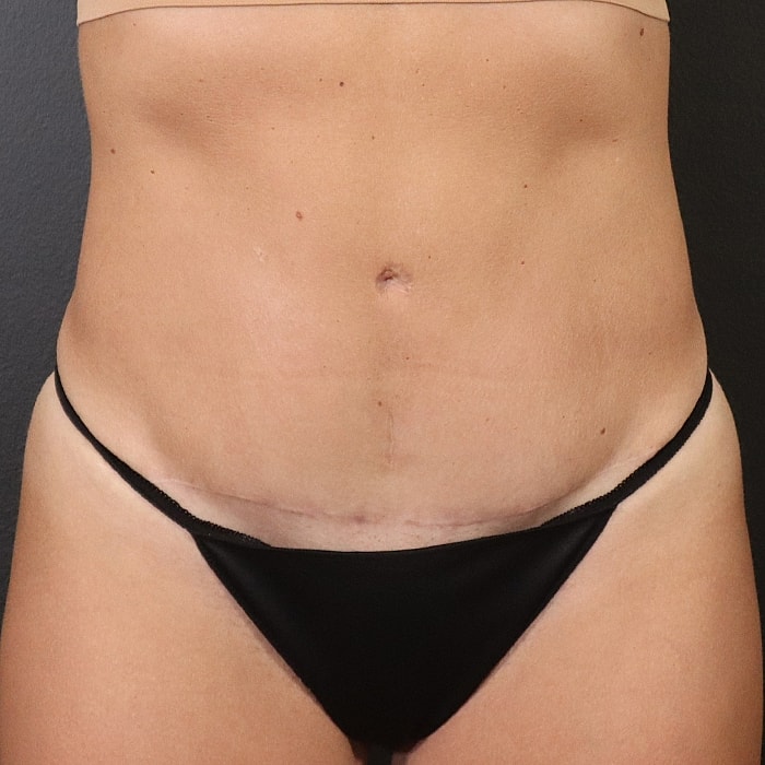 Abdominoplasty With Lipo Of Flanks Before & After