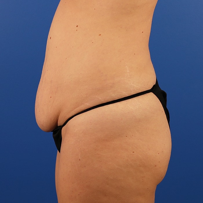 Abdominoplasty With Lipo Of Flanks Before & After