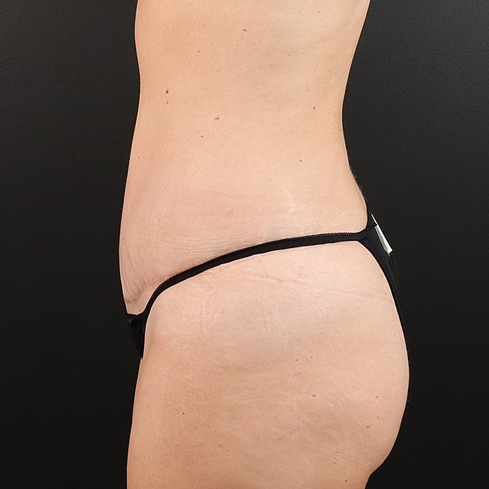 Abdominoplasty With Lipo Of Flanks Before & After