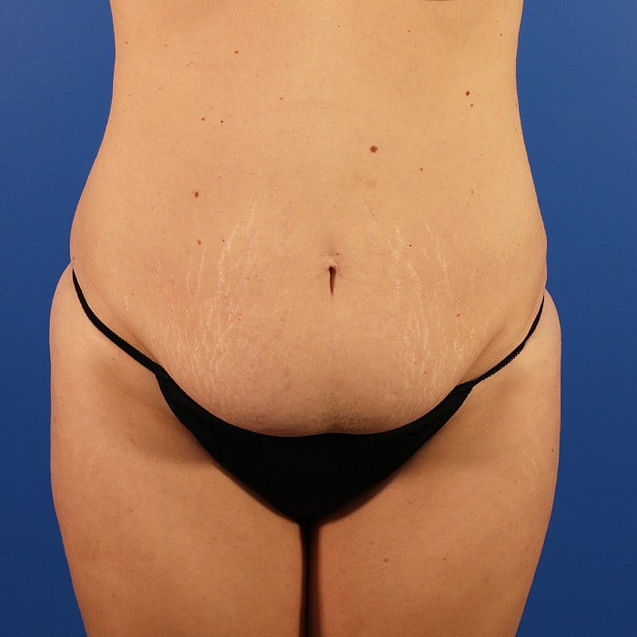 Abdominoplasty With Lipo Of Flanks Before & After