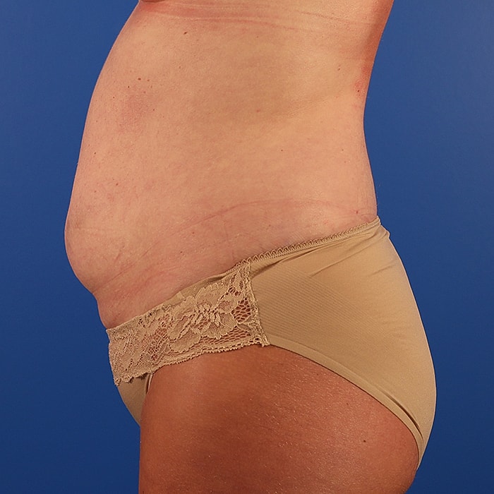 Abdominoplasty With Lipo Of Flanks Before & After