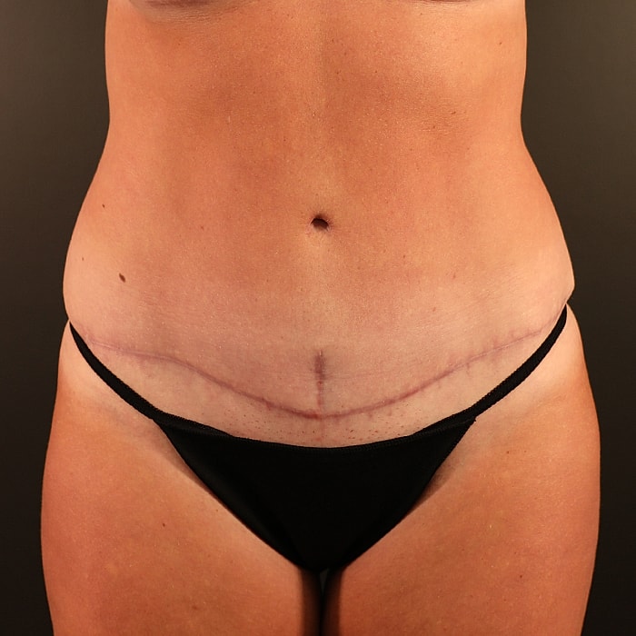 Abdominoplasty With Lipo Of Flanks Before & After