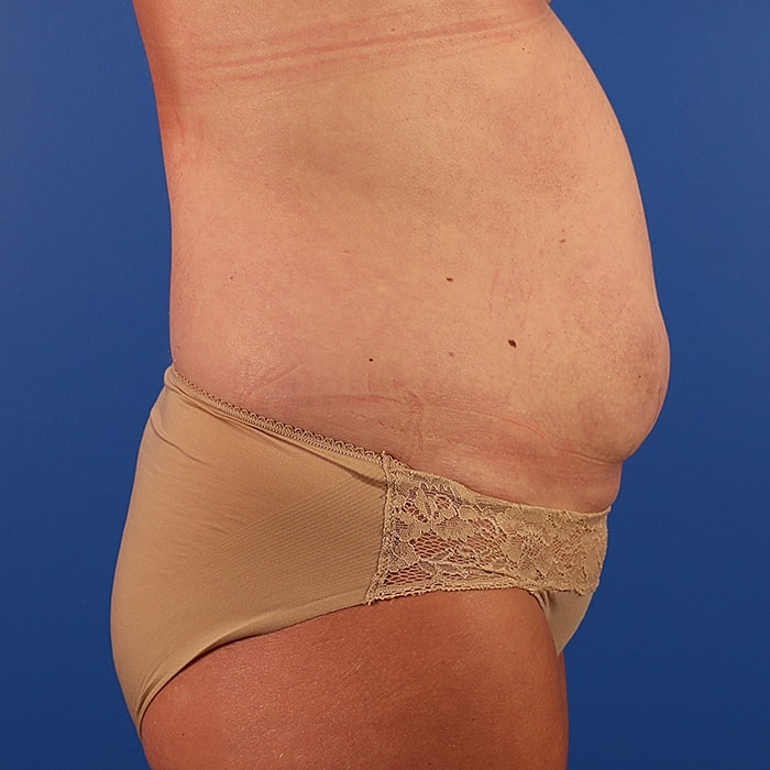 Abdominoplasty With Lipo Of Flanks Before & After