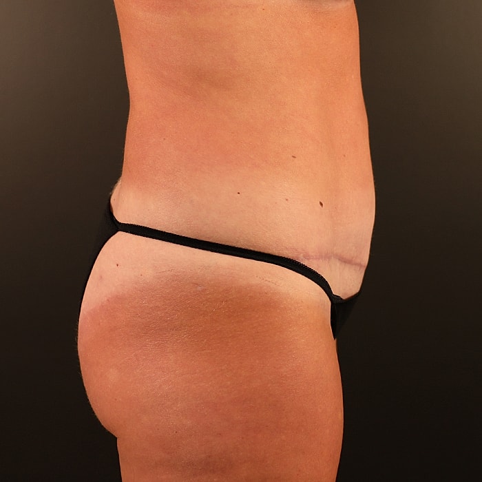 Abdominoplasty With Lipo Of Flanks Before & After