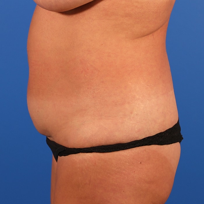 Abdominoplasty With Lipo Of Flanks Before & After