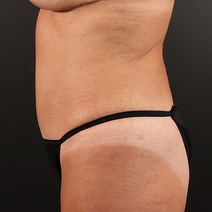 Abdominoplasty With Lipo Of Flanks Before & After
