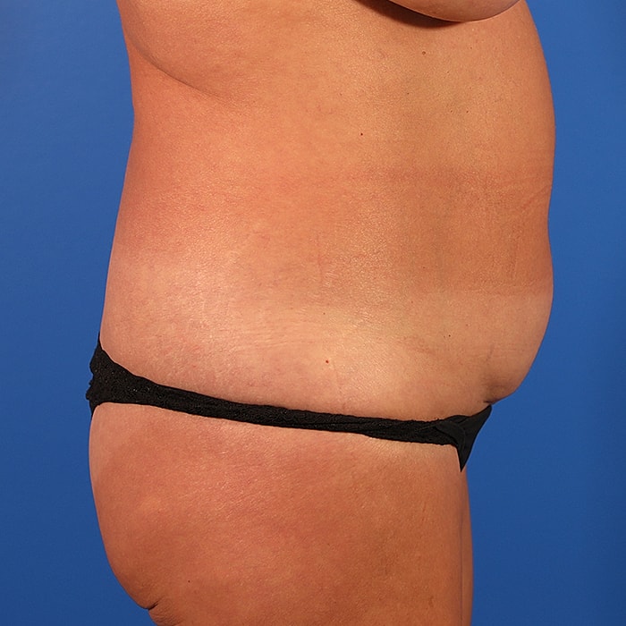 Abdominoplasty With Lipo Of Flanks Before & After