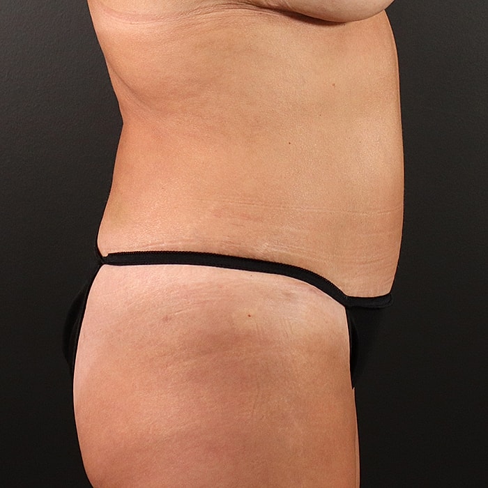 Abdominoplasty With Lipo Of Flanks Before & After