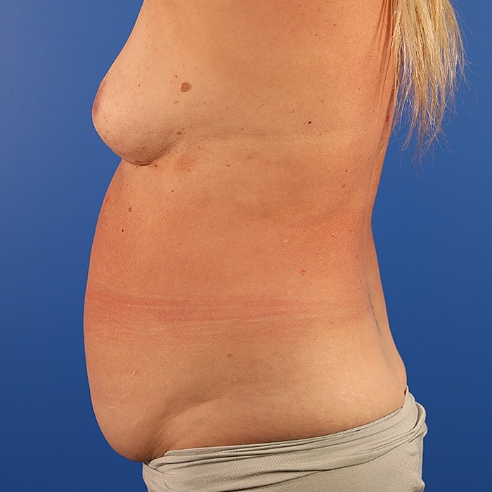 Abdominoplasty With Lipo Of Flanks Before & After