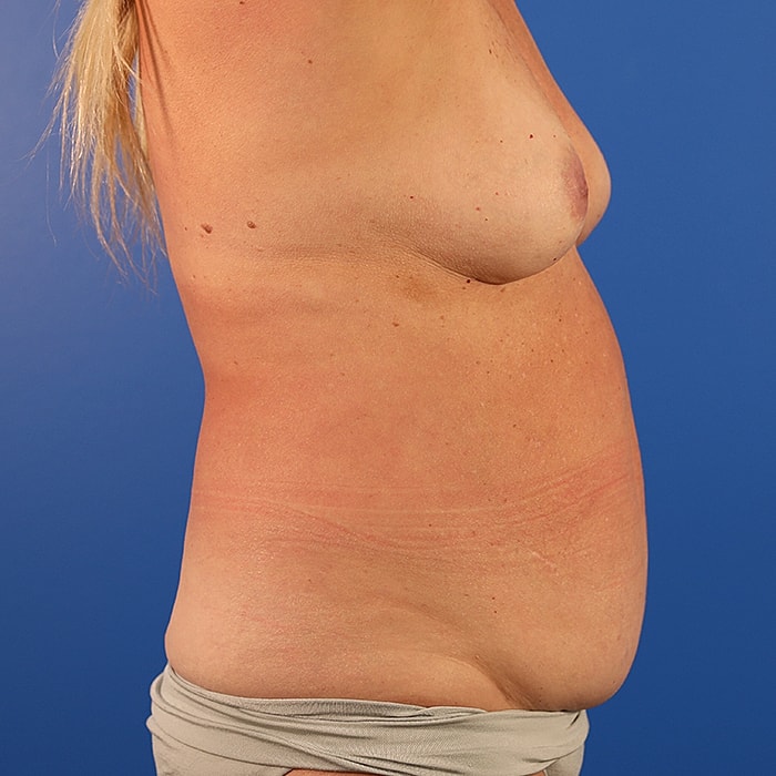 Abdominoplasty With Lipo Of Flanks Before & After