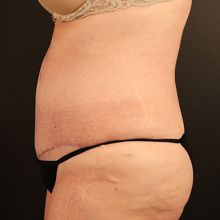 Abdominoplasty With Lipo Of Flanks Before & After