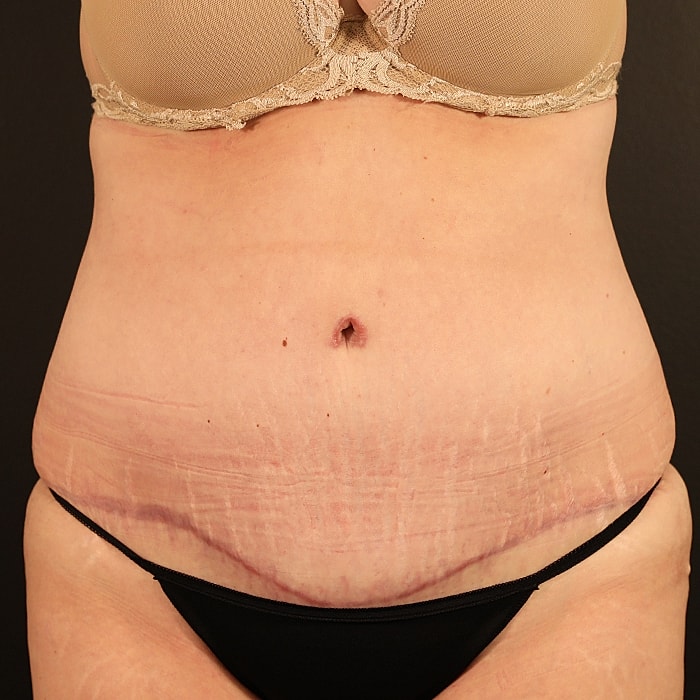 Abdominoplasty With Lipo Of Flanks Before & After