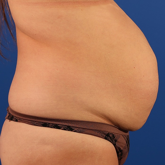 Abdominoplasty With Lipo Of Flanks Before & After