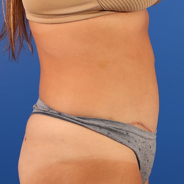 Abdominoplasty With Lipo Of Flanks Before & After