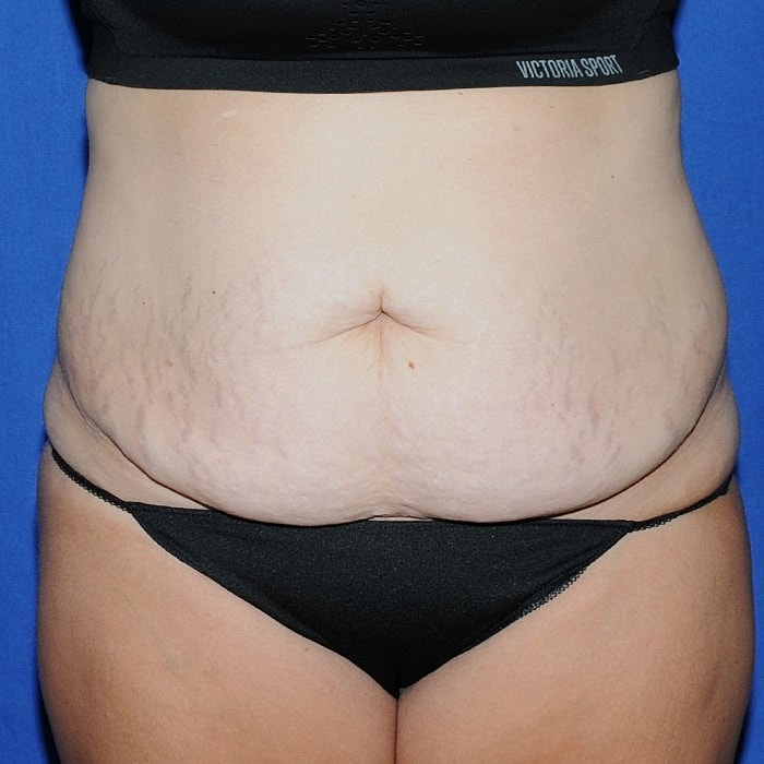 Abdominoplasty With Lipo Of Flanks Before & After
