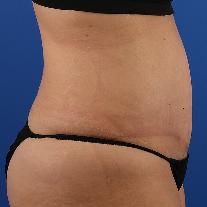 Abdominoplasty With Lipo Of Flanks Before & After