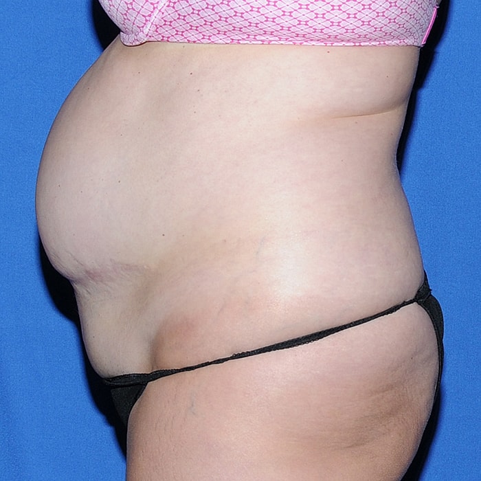 Abdominoplasty With Lipo Of Flanks Before & After