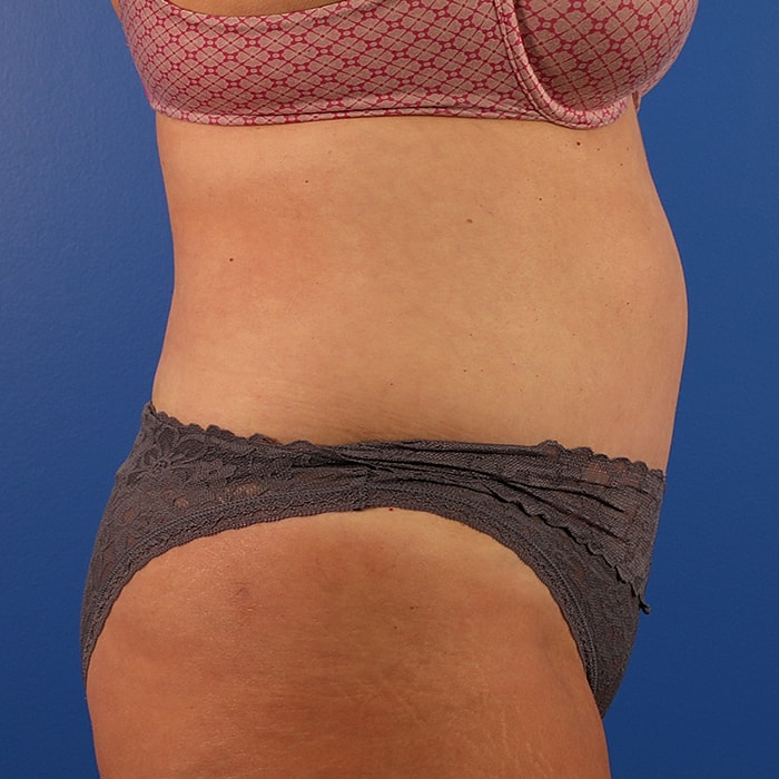 Abdominoplasty With Lipo Of Flanks Before & After