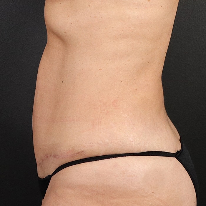 Abdominoplasty With Lipo Of Flanks Before & After