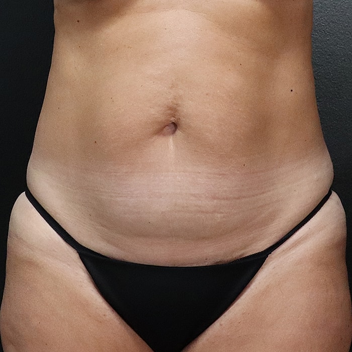 Abdominoplasty With Lipo Of Flanks Before & After