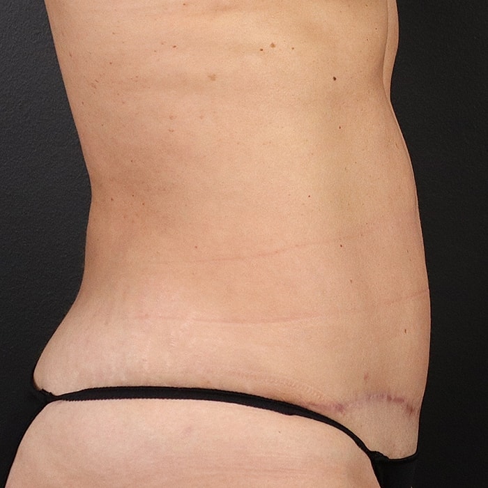 Abdominoplasty With Lipo Of Flanks Before & After