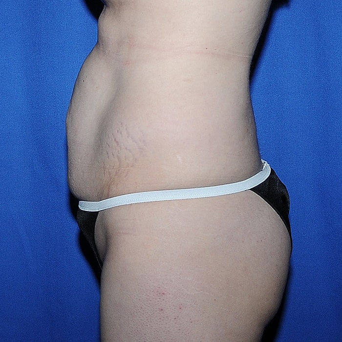 Abdominoplasty With Lipo Of Flanks Before & After