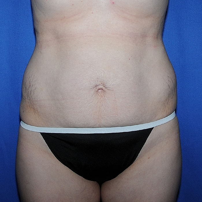 Abdominoplasty With Lipo Of Flanks Before & After