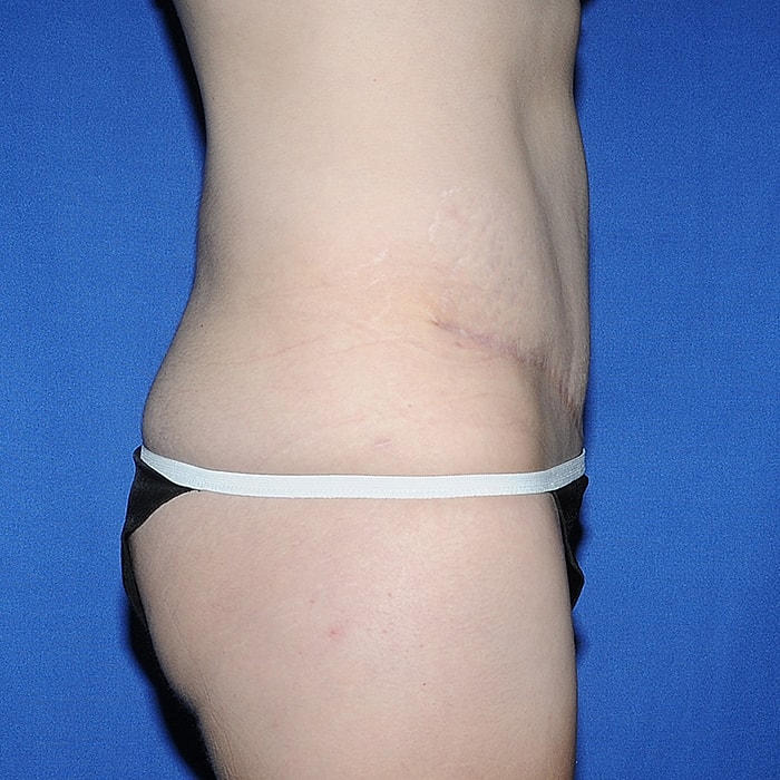 Abdominoplasty With Lipo Of Flanks Before & After
