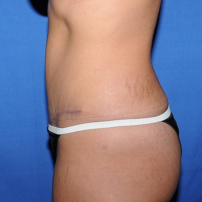 Abdominoplasty With Lipo Of Flanks Before & After
