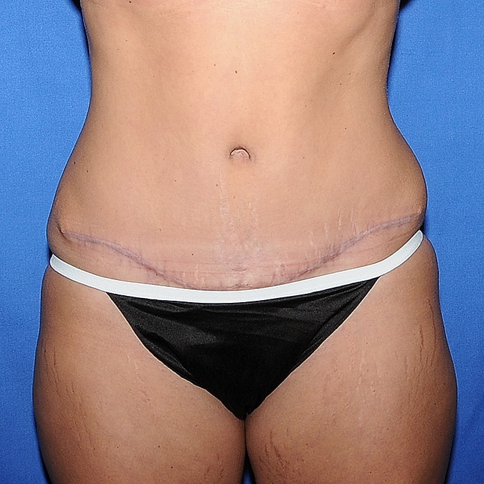 Abdominoplasty With Lipo Of Flanks Before & After