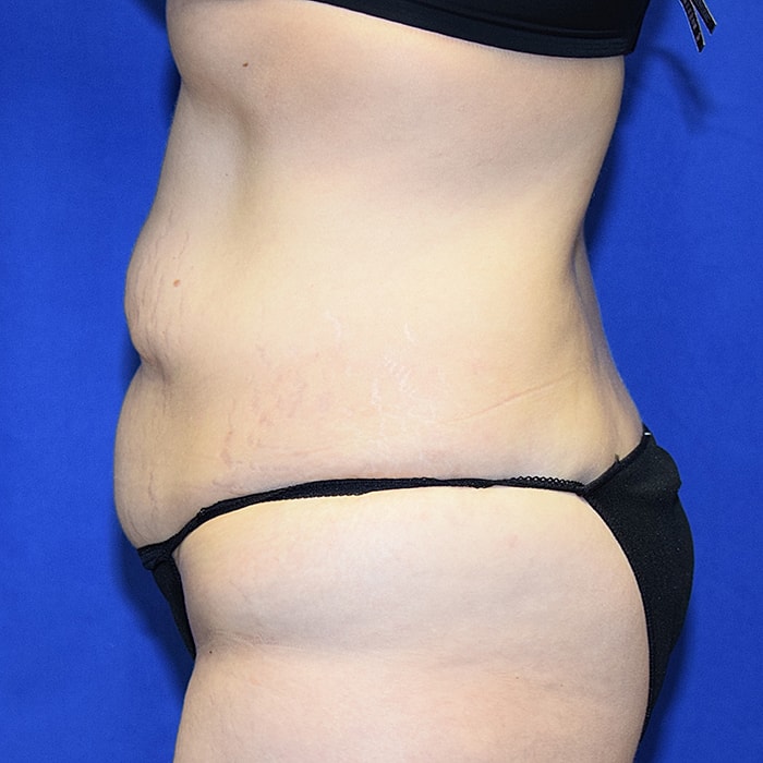 Abdominoplasty With Lipo Of Flanks Before & After