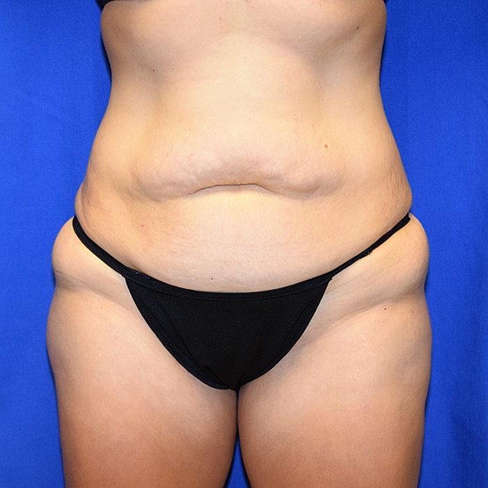 Abdominoplasty With Lipo Of Flanks Before & After