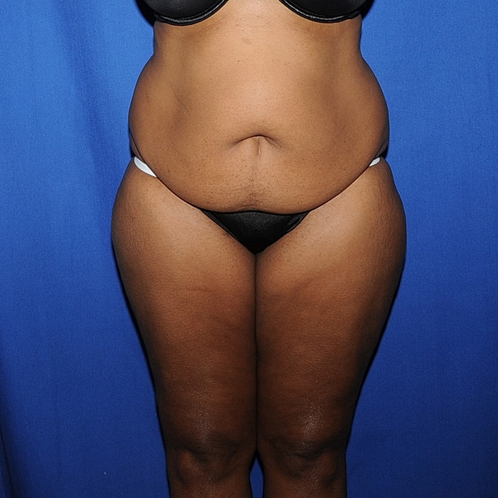 Abdominoplasty With Lipo Of Flanks Before & After