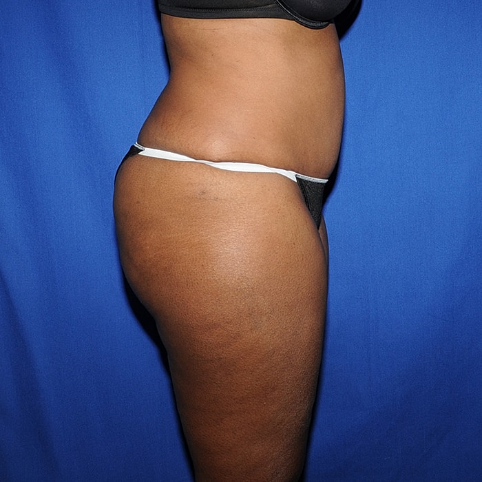 Abdominoplasty With Lipo Of Flanks Before & After