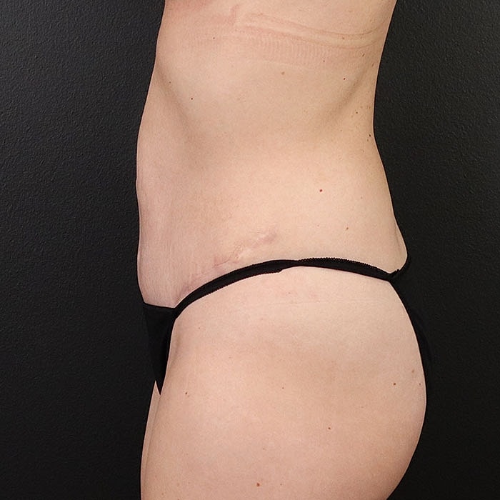 Abdominoplasty With Lipo Of Flanks Before & After