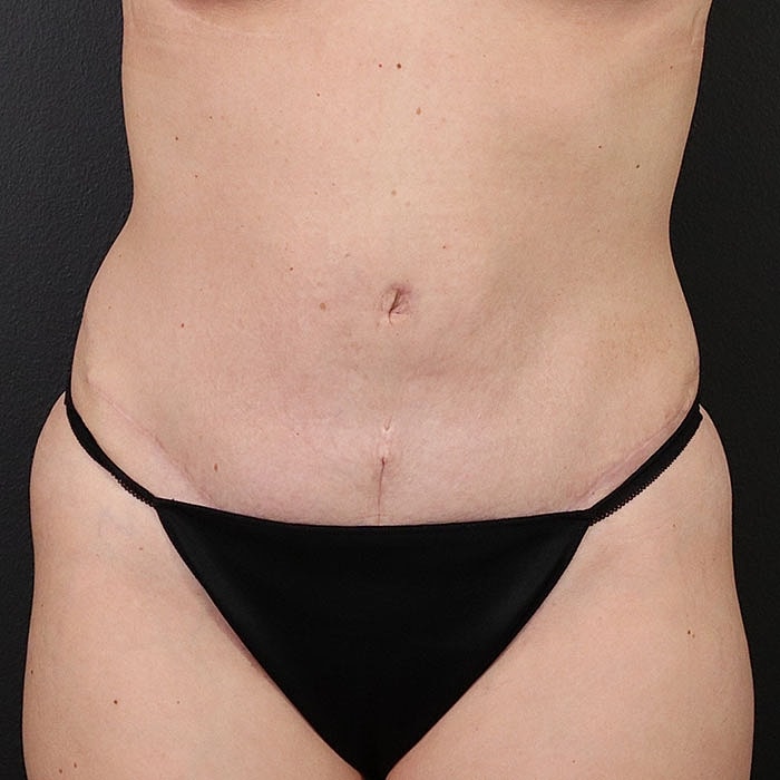 Abdominoplasty With Lipo Of Flanks Before & After
