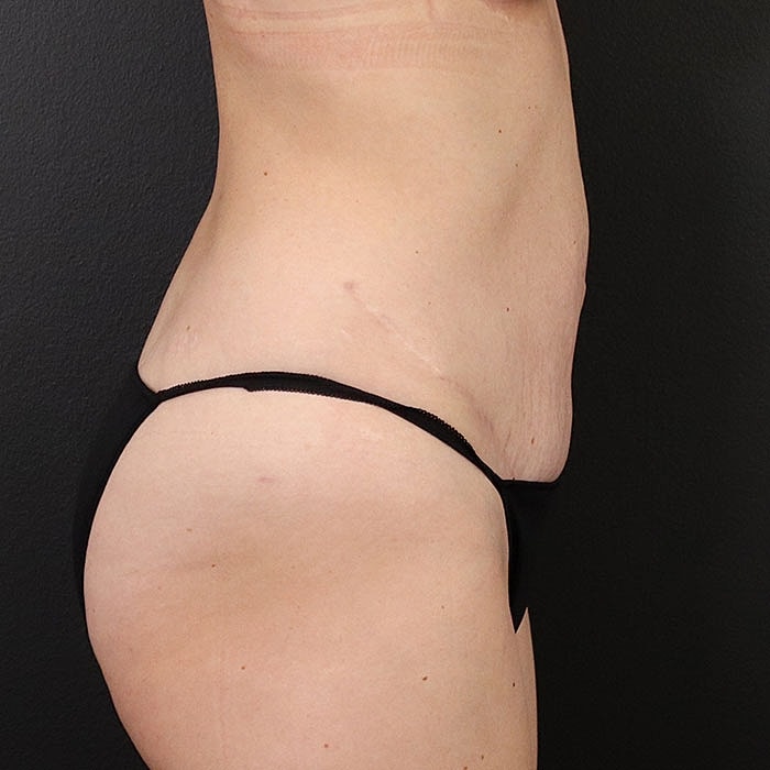 Abdominoplasty With Lipo Of Flanks Before & After