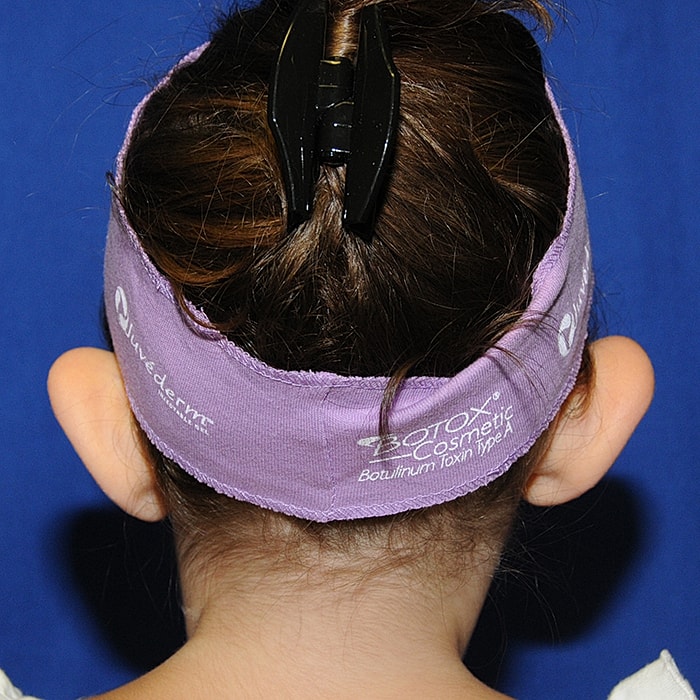 Otoplasty Before & After