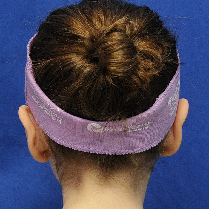 Otoplasty Before & After