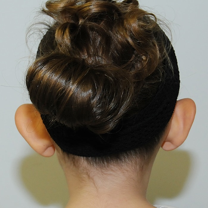 Otoplasty Before & After